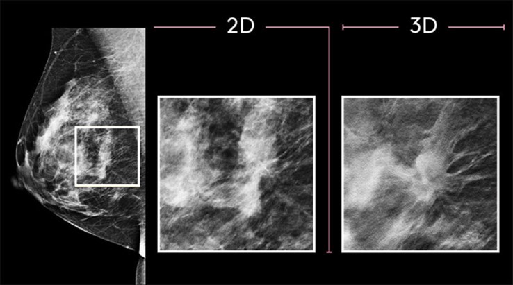 Mammography scan image