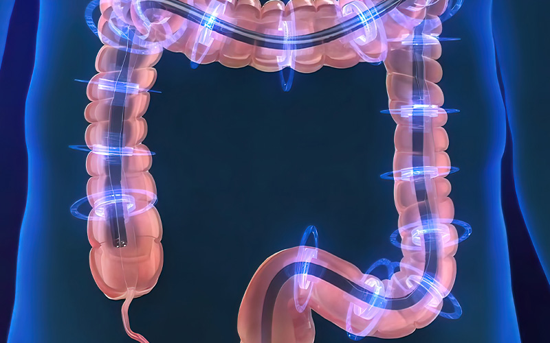Colonoscopy