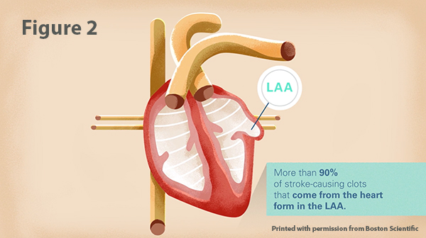 Illustration of the human heart and where clots typically form in the left atrial appendage