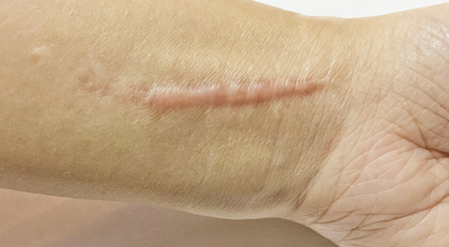 Scars