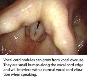  Vocal Cord Nodes with caption