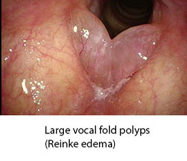 Large Vocal Fold Polyps Reinke edema 2 with caption