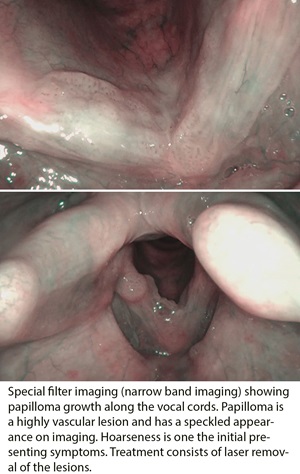 Laryngeal papillomatosis lesion