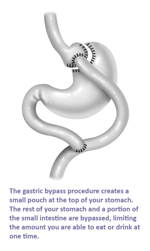 The gastric bypass procedure creates a small pouch at the top of your stomach. The rest of your stomach and a portion of the small intestine are bypassed, limiting the amount you are able to eat or drink at one time.