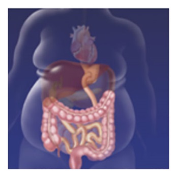 Gastric Bypass creates a stomach pouch out of a small portion of the stomach and attaches it directly to the small intestine, bypassing a large part of the stomach and duodenum.