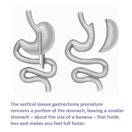 The vertical sleeve gastrectomy removes a portion of the stomach, leaving a smaller stomach – about the size of a banana – that holds less and makes you feel full faster.