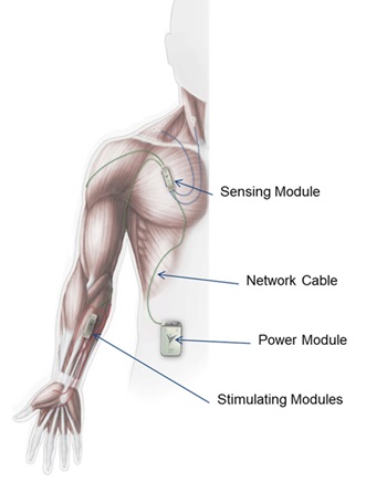 Arm and Hand Movement after SCI