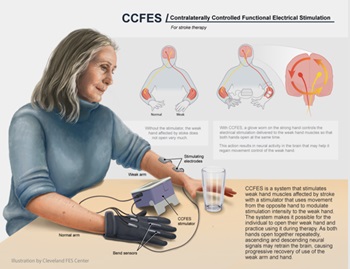 Arm and Hand Movement after Stroke