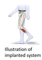 Research at MetroHealth Rehabilitation Institute Illustration of implanted system