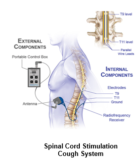Spinal Cord Stimulation Cough System