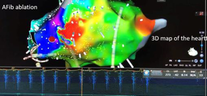 Atrial ablation diagram