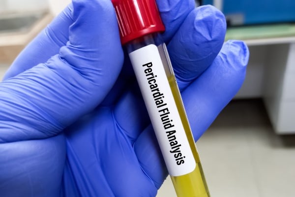 A test tube labeled Pericardial Fluid Analysis