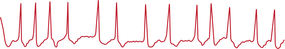 ECG chart showing irregular rhythms