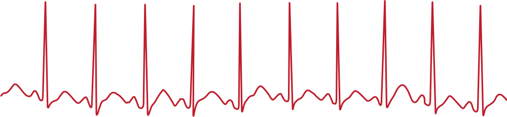 ECG chart showing fast rhythm