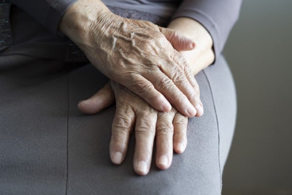 A woman's hands with noticeable varicose veins