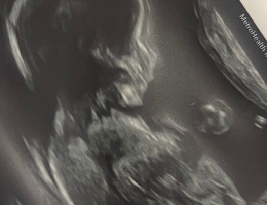 Ultrasound image of a baby