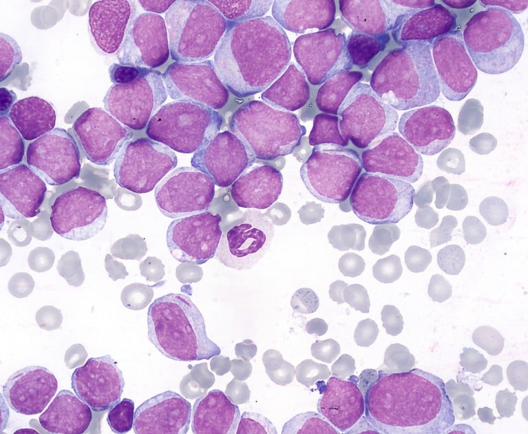 Researchers Identify Approach to Overcome Drug Resistance in Leukemia