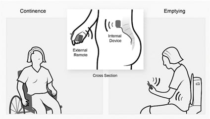 Diagram of how electrical stimulator works