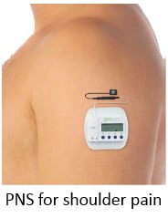 example of PNS for shoulder pain