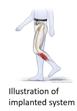 Illustration of implanted system