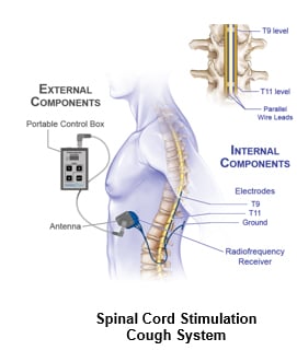 Diagram of spinal cord stimulation cough system