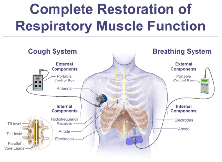 PMR Complete Restoration of Respiratory Muscle Function