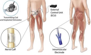 Illustration of implanted system for standing function